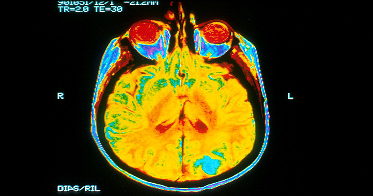 Клініка Мейо використовує штучний інтелект для удосконалення методів лікування пухлини головного мозку